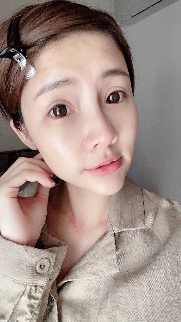 【瘦小臉注射】星和診所-館前路(台北)- -下巴讓我很困擾，下定決心「我要拯救我的短下巴！」！！～ -跟蓓蓓一起變美麗